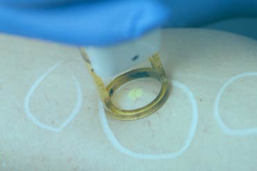 Medical laser treatment for vein removal