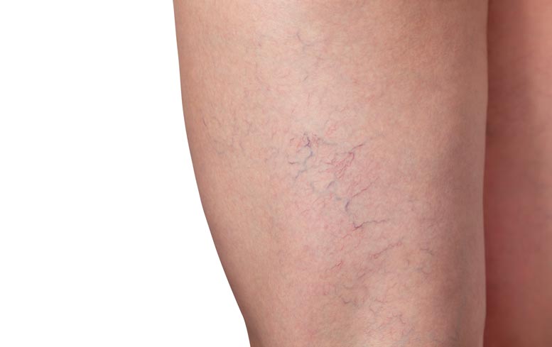 Spider veins on thigh can be treated with sclerotherapy