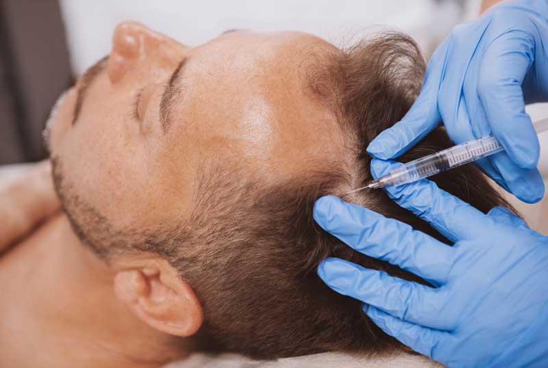 PRP Hair Injection