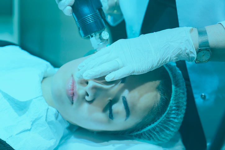 Micro-needling treatment to keep your skin youthful