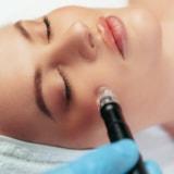 RF Microneedling Reduces Wrinkles