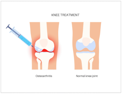 Treatment of Knee Injuries With Platelet Rich Plasma (PRP) - MARC (Gastonia. NC)