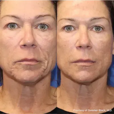 RF Microneedling - Before and After Photo