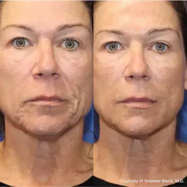RF Microneedling - Before and After Photo