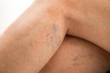 Spider veins most commonly affect legs due to risk factors which can be avoided