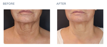 Sofwave™ Treatment Before After (Neck)