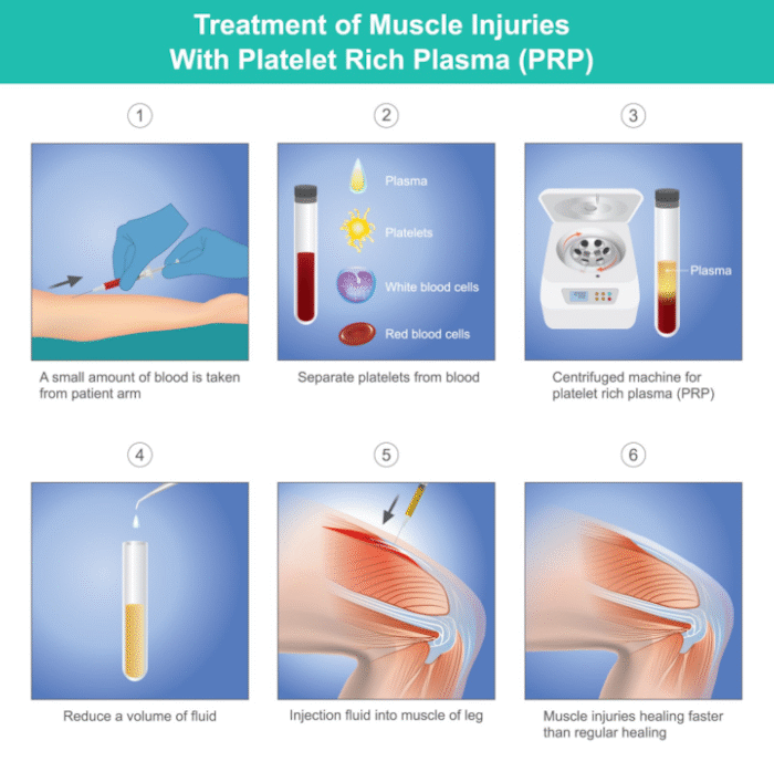 Treatment of Muscle Injuries With Platelet Rich Plasma (PRP) - MARC (Gastonia. NC)