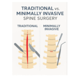 Minimally Invasive Spine Surgery