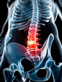 Benefits of Transforaminal Lumbar Interbody Fusion (TLIF) Surgery