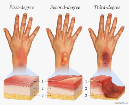 Burn Degree