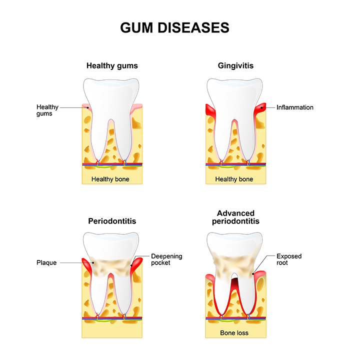 Deep Cleaning - Gum Disease and the Heart