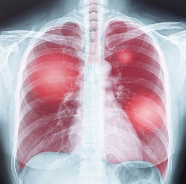 lung chest xray illustration